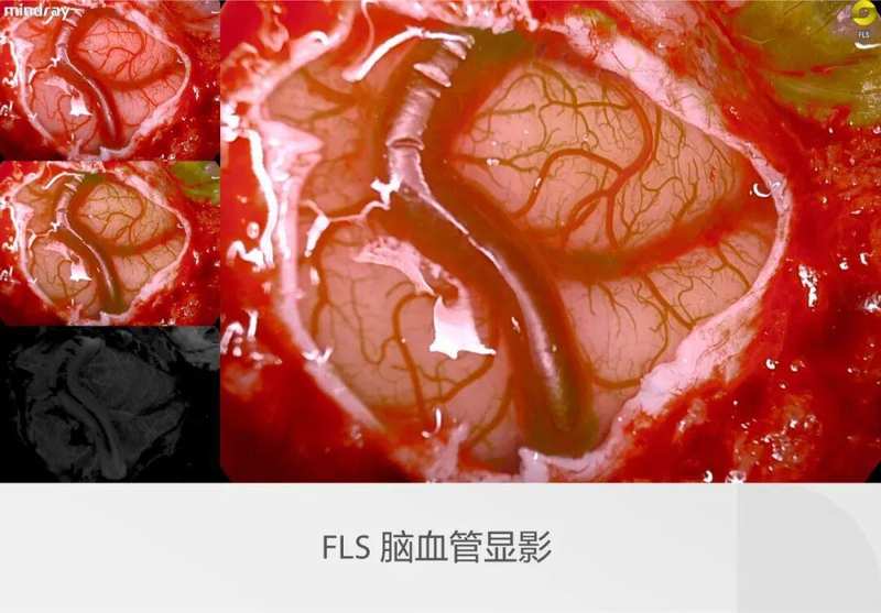 迈瑞全域荧光智能影像平台,探索精准外科未达之“镜” 新闻