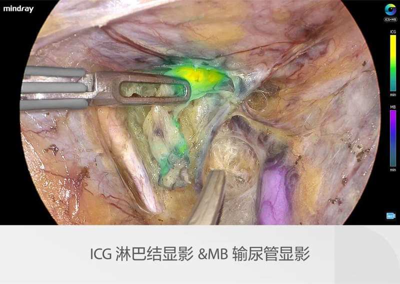 迈瑞全域荧光智能影像平台,探索精准外科未达之“镜” 新闻